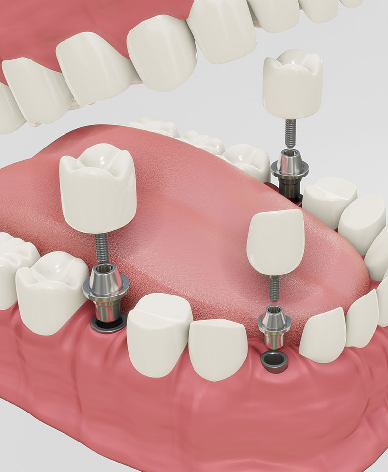 傳統植牙重建方式需要多顆植體、多次補骨及軟組織增補，時間及費用都將大大增加，造成病患的不方便。